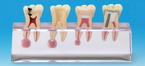 endodoncia malaga