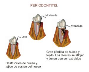 periodontitis