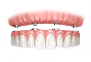 implantes all on four