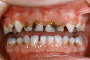 Caries de la lactancia o biberon