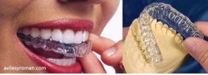 Tipos de feruals dentales