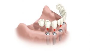 Tipos de protesis dentales