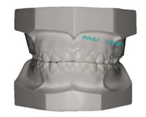 Atriccion Dental