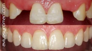 Importancia de la protesis dental sobre implantes