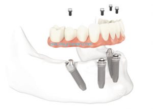 protesis-allonfour-dentistas-malaga