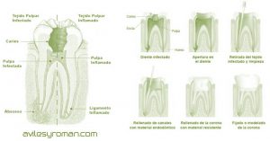 Endodoncia