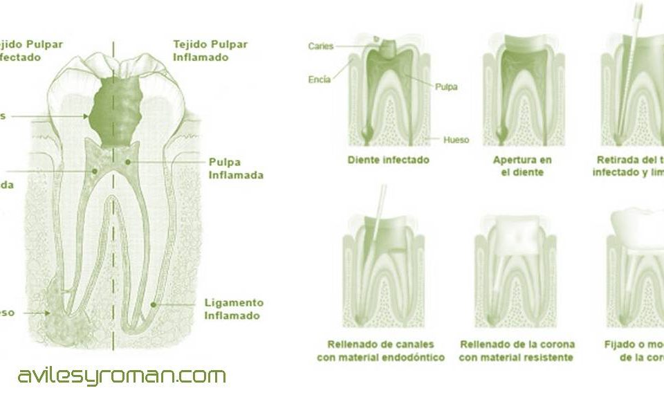 Endodoncia