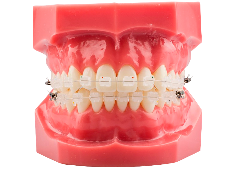 Ortodoncia Estetica