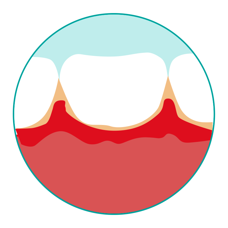 Periodontitits