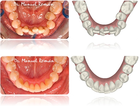 ortondoncia_invisalignantesdespues