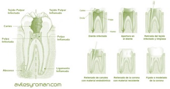 endodoncia-preguntas-frecuentes