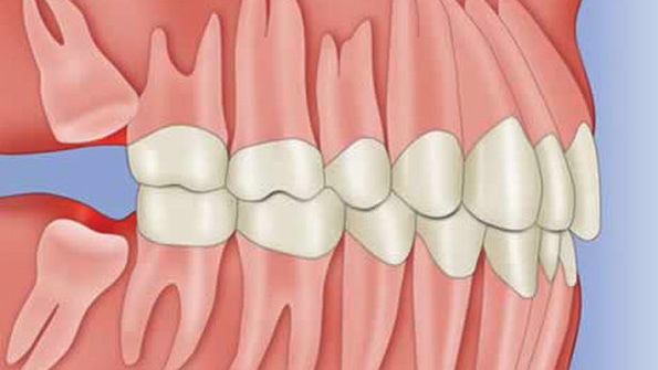 muelas-del-juicio-dibujo | Clinica Dental Aviles y Roman - Clinica Dental  Malaga