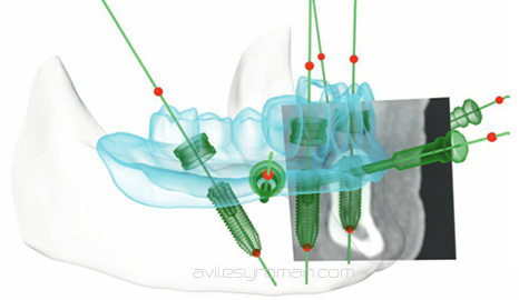 Implantes dentales por ordenador en Malaga