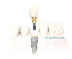 Implante Dental Malaga