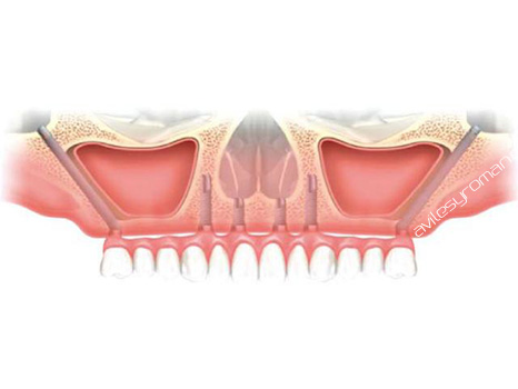 implantes-cigomaticos