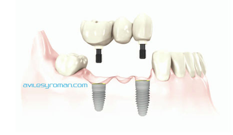 implantes dentales en malaga