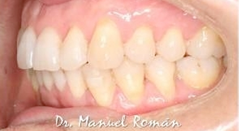 invisalign-malaga-6