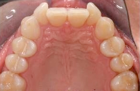 invisalign-malaga-7