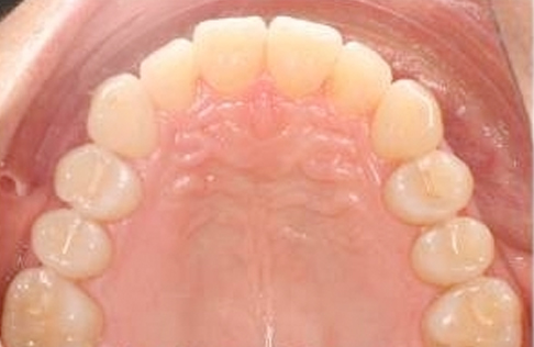 invisalign-malaga-8