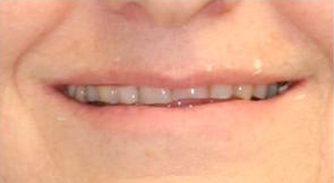 ortodoncia-implantes-01