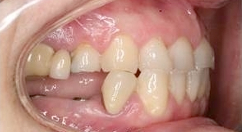 ortodoncia-implantes-05