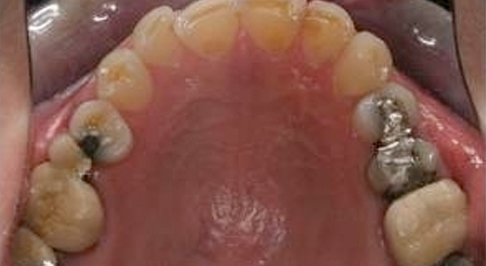 ortodoncia-implantes-09