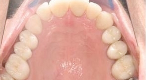 ortodoncia-implantes-10