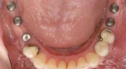 ortodoncia-implantes-11