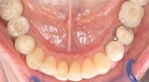 ortodoncia-implantes-12