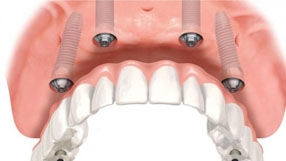 Implantes Dentales en Malaga