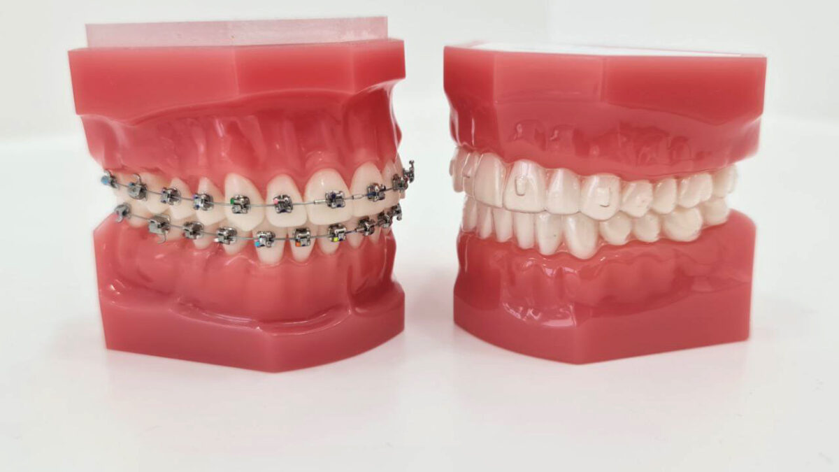 Ortodoncia invisible vs ortodoncia con brackets