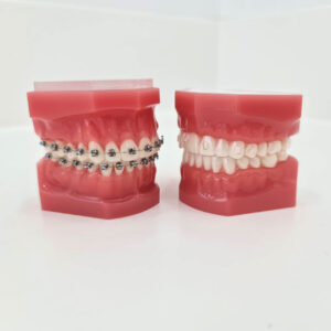 Ortodoncia invisible vs ortodoncia con brackets