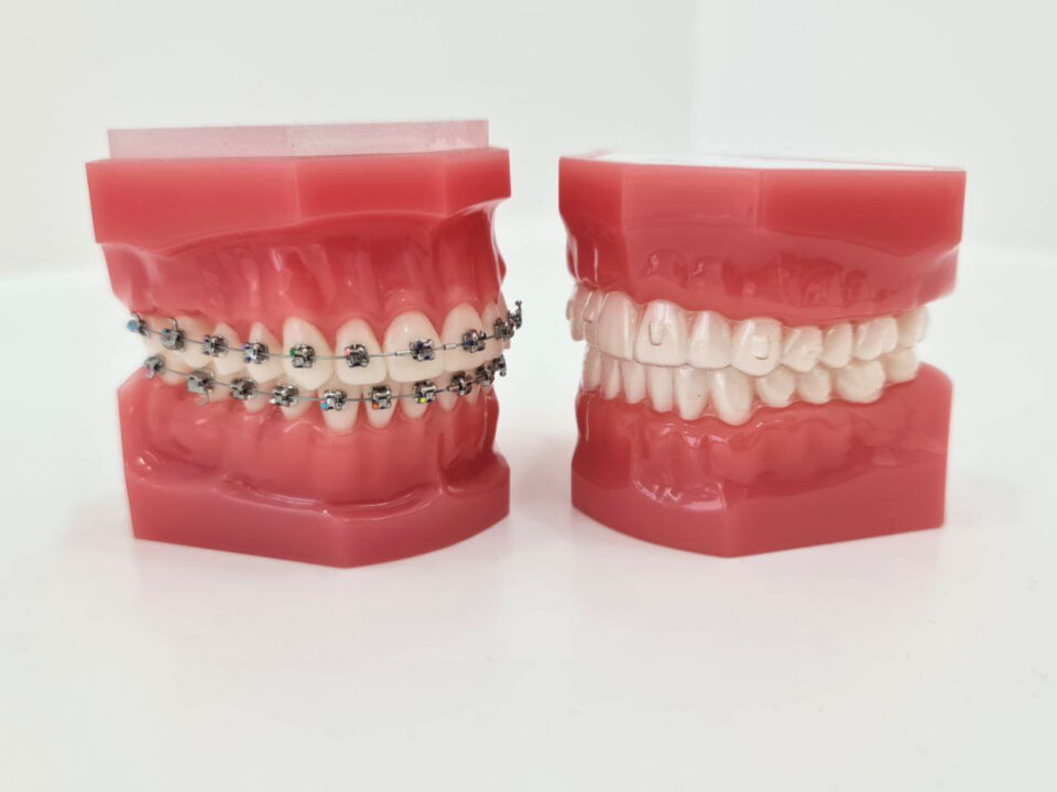 Ortodoncia invisible vs ortodoncia con brackets